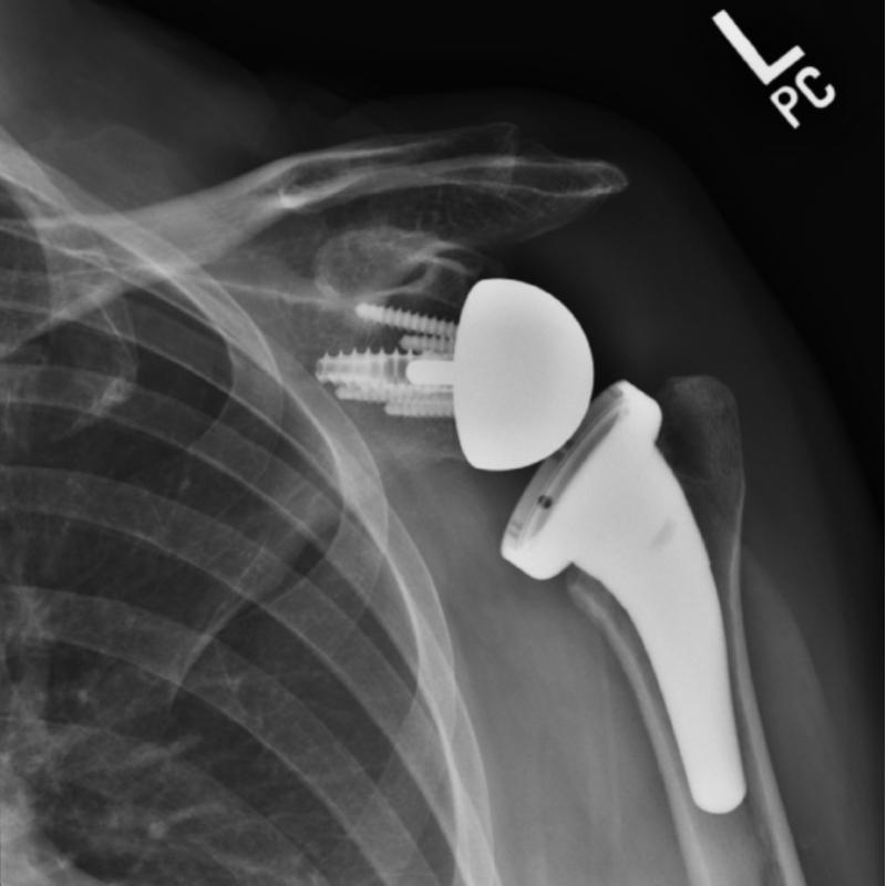 Shoulder Replacement